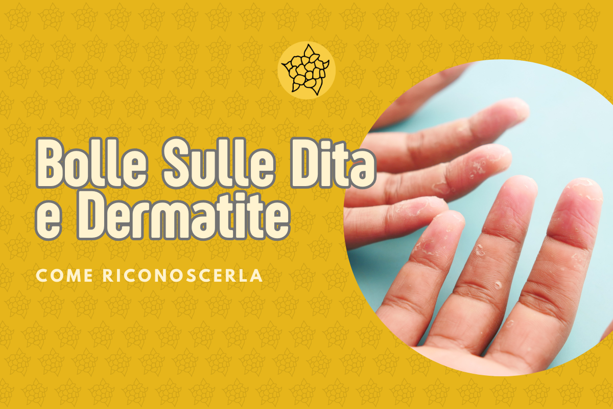 bolle sulle dita e dermatite