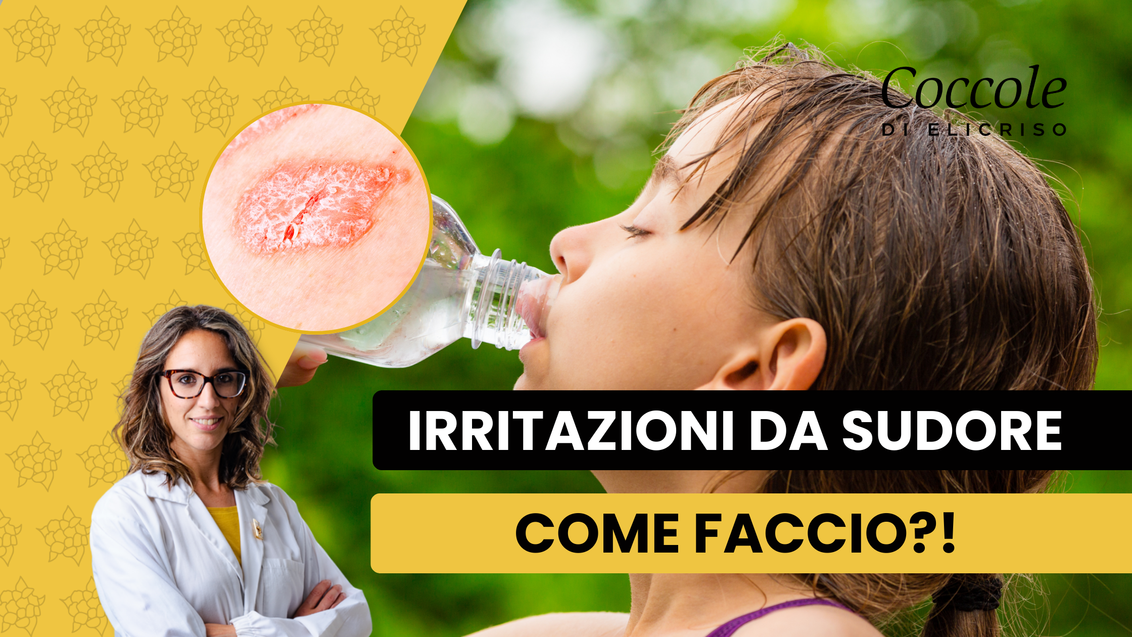 Come Gestisco l'Irritazione da Sudore nel mio bambino. Consigli di Esperti